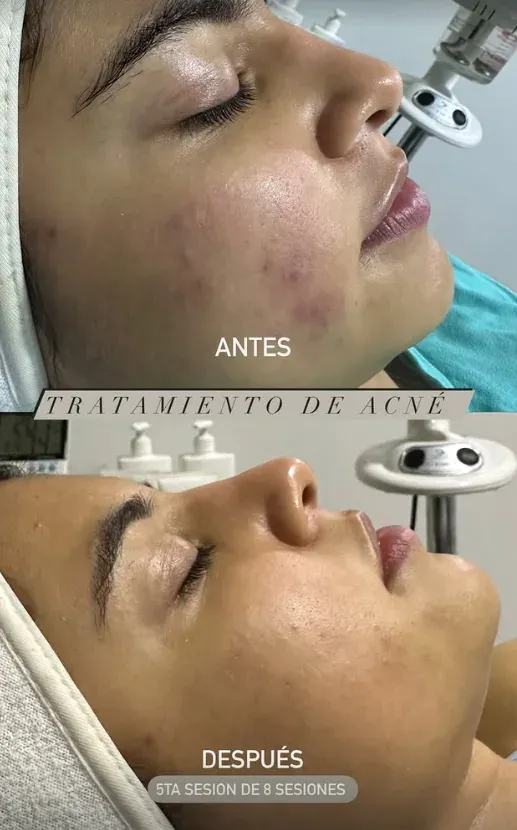 Antes y después — Tratamiento de acné